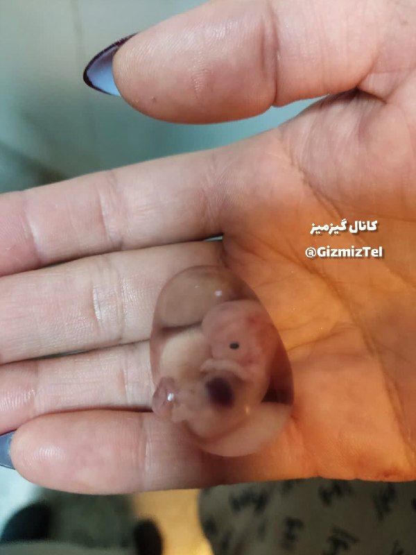 کانال گیزویز: اینو تو گالریم پیدا کردمدو سال پیش که اورژانس بودم یه خانومی ساعت ۳ صبح اومد با خونریزی واژینال و جفت رو دفع کرده بود ۹ 