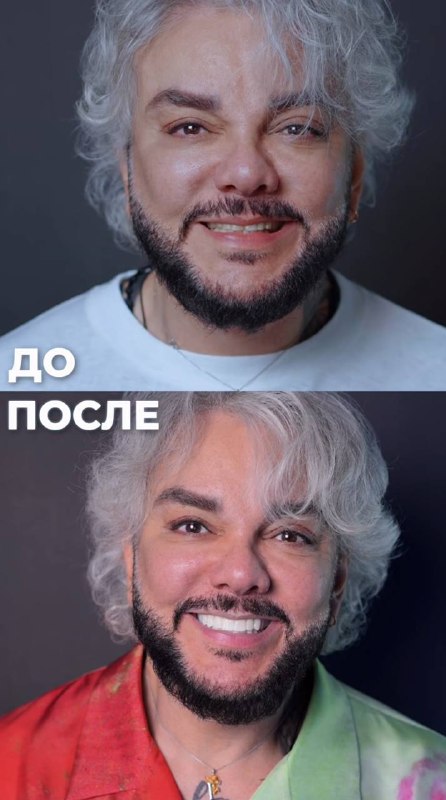 Киркоров собирается делать новые зубы.