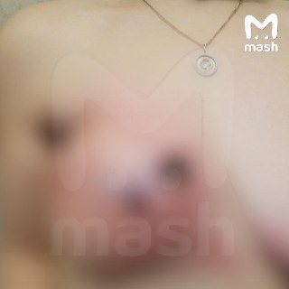 Жительница Тулы год прожила с салфеткой в груди — которую забыл внутри пластический хирург во время операции в питерской клинике. Из-за врачебной ошибки у женщины начался некроз и абсцесс тканей.По данным Mash, Екатерине вырезали молочную железу из-за опух