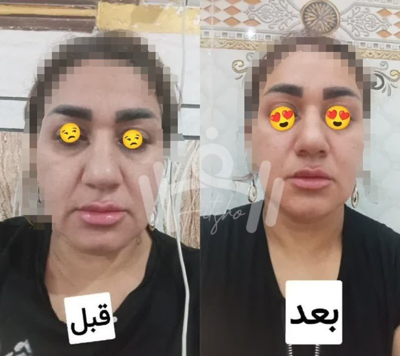 فیت شو | زندگی سالم🌱💃🏻: .مثل این نتیجه جذابی که از یکیاز شما قشنگاست، شمااا فقط قبل و بعدش رو ببین😌مگه همچین چیزی میشههه؟از لیفت گونه و رفع سیاه