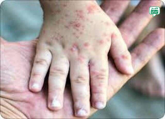 خبر تهران: بازگشت آبله‌مرغاندکتر علیرضا سلیمانی متخصص بیماری‌های عفونی:بیماری زونا می‌تواند با درد، سوزش و بثورات پوستی یک‌طرفه آغا