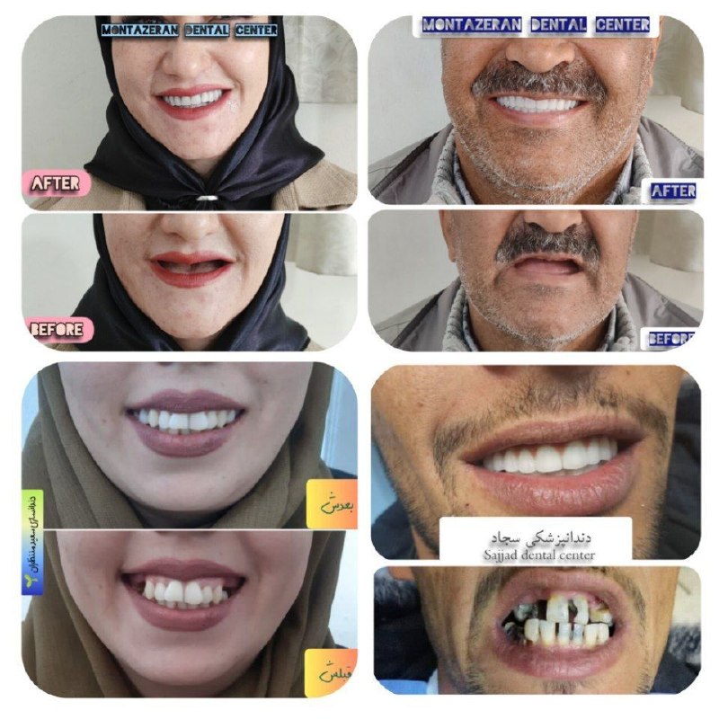اخبار شهرستان کلات نادر: ✨ لابراتور تخصصی دندانسازی منتظران 🦷 بیش از ۵۰ سال تجربه در ارائه خدمات حرفه ای دندانسازی 🚀 تحویل فوری دندان های مصنوع