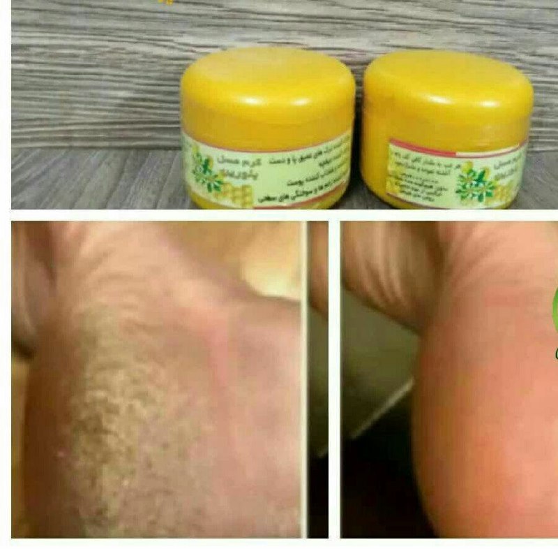 مزاج شناسی: #کرم_عسل_بلورین _حرفه ای 🤩✅درمان ترک های عمیق پا و دستلینک کانال👈@mezajshenasi1358لینک فروشگاه👈@foroshgah1358@gholipor13