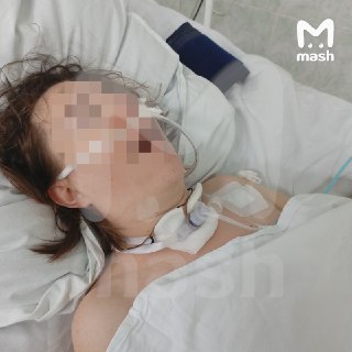 Клиническую смерть пережила роженица из Нижегородской области из-за врачебной ошибки — предварительно, ей неправильно установили кислородную трубку в трахею после планового кесарева сечения. Девушка почти 2 месяца в вегетативном состоянии и останется инвал