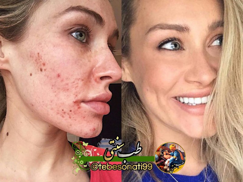 🍏طب سنتی🍏: نتیجه استفاده از جوش شیرین روی پوست زن جوان تنها در 1 هفته👇زن جوان با استفاده از ماسک های خانگی به کمک جوش شیرین توانست