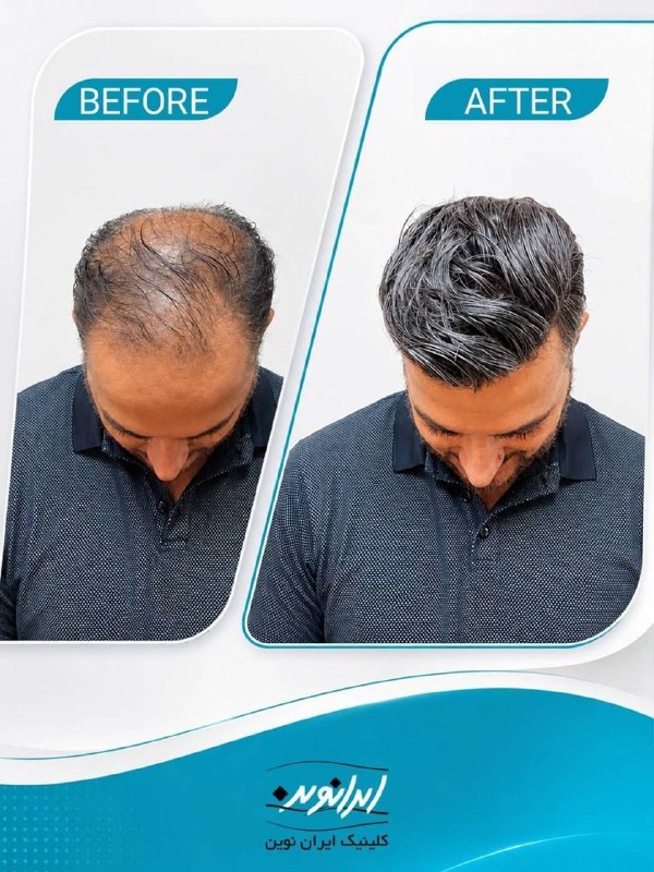 خبرفوری: 🏥 کلینیک ایران نوین قدیمیترین و بزرگترین مرکز کاشت موکاشت مو (Nanograft) با ۵۰٪ تخفیف جشنواره تابستان💰 قیمت نهایی: از