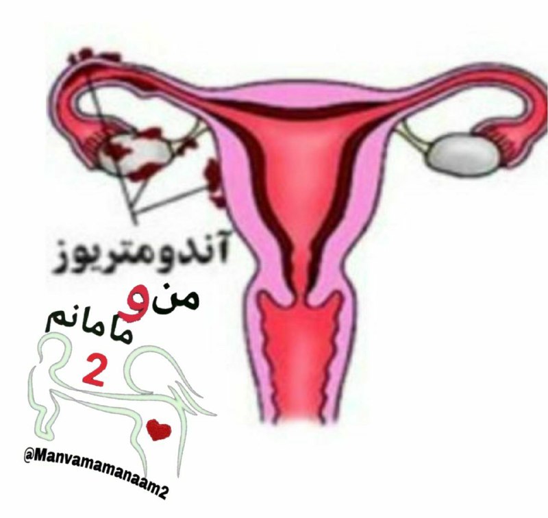 مجله 🌸مادر زيبا،مادر سالم🌸: 🔆 #آندومتریوز ♥️ آندومتریوز یک بیماری مزمن دستگاه تناسلی است که در آن سلولهای آندومتر در جایی که نباید رشد میکنند، یعن
