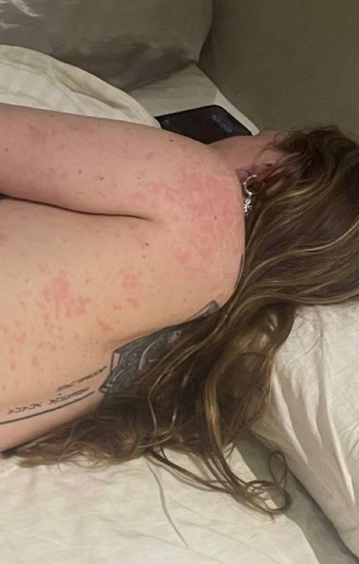 Прилетела с крапивницей по всему телу и отеком квике — уже в больнице Отменяю работу и встречи на ближайшие дни. Надеюсь, на всеобщее понимаете 🕊️Прилетела с крапивницей по всему телу и отеком квике — уже в больнице Отменяю работу и встречи на ближайшие дни. Надеюсь, на всеобщее понимаете 🕊️