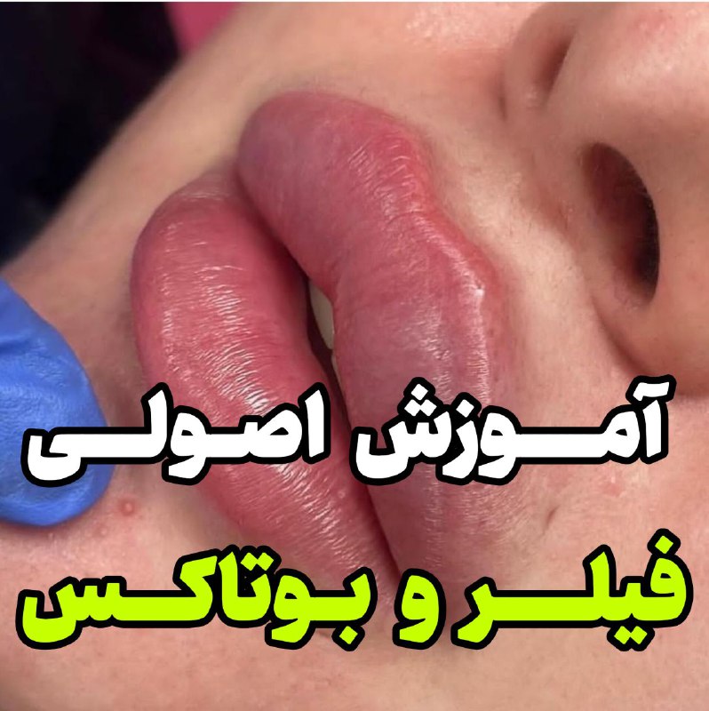 👩‍⚕️صفر تا صد پرستاری👨‍⚕️: ✔️آموزش رایگان فیلر و بوتاکس‼️هر روز کلی مطالب جذاب آموزش میدم🔥 بوتاکس میگرن هدیه من به تو🌐 همین الان عضو کانال شو 👇http