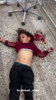 בת שבע, עם רסיסים בראש ובגוף דנה אבו ורדה שרדה את ההפצצה הישראלית, אבל המאבק שלה עם השפעותיה עדיין נמשך.