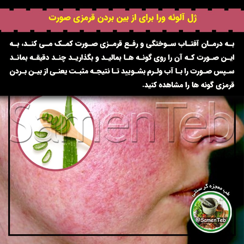 🍃طبِ معجزه‌گرِ سنتی🍂: ✅ ژل آلوئه ورا برای از بین بردن قرمزی صورت🤦‍♀به درمان #آفتاب_سوختگی و رفع قرمزی صورت کمک می کند، به این صورت که آن را رو