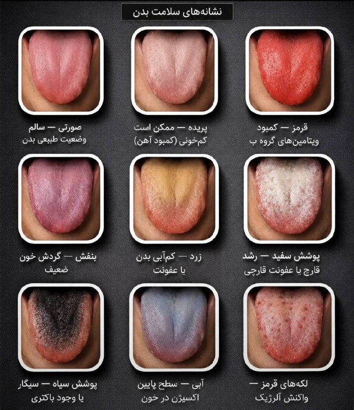 ایـده بانوان: ✅ زبان شما اطلاعات زیادی رو درباره‌ی وضعیت سلامتی شما بیان میکنه💃 @ZaneEmrooozi