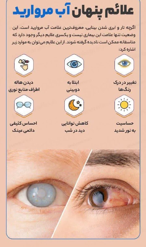 🇮🇷تحت محل🇮🇷: علائم پنهان آب مروارید#بسته_سلامت @tahtemahal