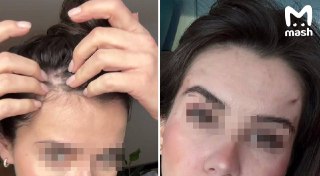 Хирурга элитной московской пластической клиники обвинили в домогательствах после неудачной процедуры по подтяжке лица. Пострадавшая утверждает: за 265к рублей врач изуродовал её и во время осмотров требовал показать грудь.Эльвира из Казани прилетела в стол