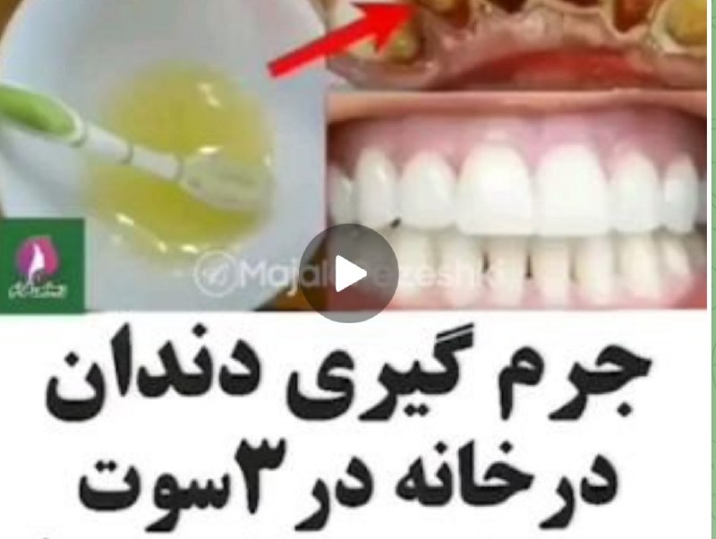 ClipRaghs Dance: جرم گیری دندون🦷 در خانه آسون و فوریمشاهده فیلم آموزشی»»»»»»»»