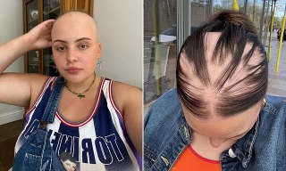 Если болели ковидом — готовьтесь лишиться волос. Учёные выяснили, что COVID-19 провоцирует телогеновую алопецию — это когда организм переводит патлы в фазу покоя, из-за чего они начинают массово выпадать.24-летняя англичанка Лидия Морли (на фото), которая 