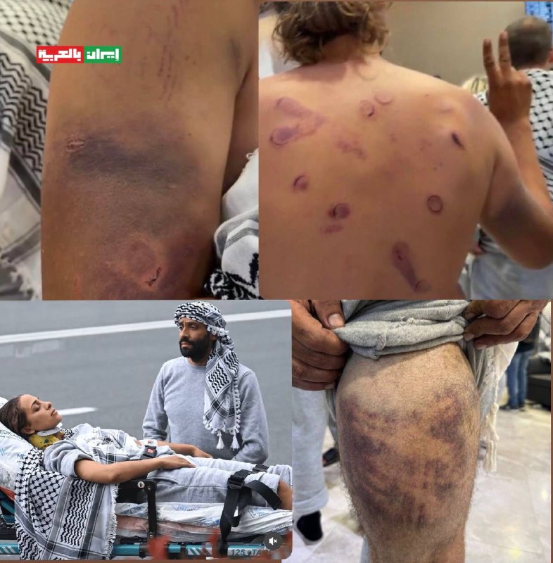 اعتداءات وحشية.. آثار تعذيب جيش الاحتلال لنشطاء أسطول الصمود التركي الذي قرصنه الاحتلال وا