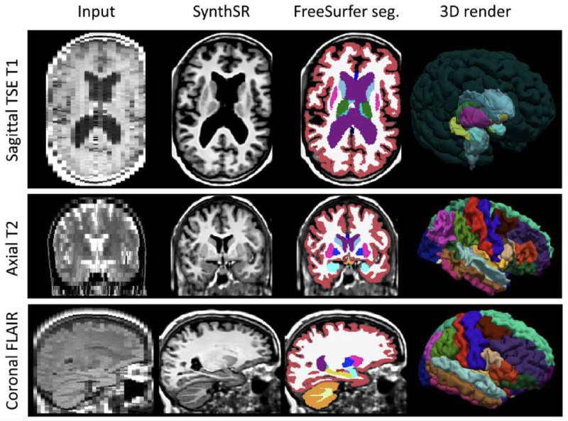 AI for 医疗 所有人都能从中受益Juan Eugenio Iglesias: SynthSR 2.0 is out in @ScienceAdvances and publicly available ( 