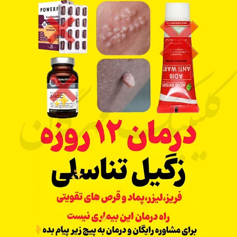 کانال آخرین قیمت: 🔷️درمان ۱۲ روزه زگیل🔷️🔴 زگیل چهارمین ویروس خطرناک دنیاست که علاوه بر خودت به اطرافیانت هم منتقل میشه. نه لیزر، نه فریز و