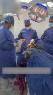 An Egyptian doctor treats tremors in moments using precise brain surgery. social sky