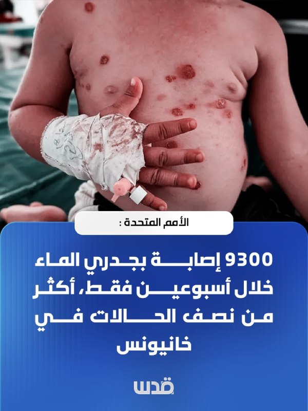 האו"ם: 9,300 מקרים של אבעבועות רוח בשבועיים בלבד, יותר ממחצית מהמקרים בחאן יונס
