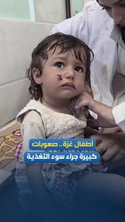 أطفال غزة يعالَجون من سوء التغذية بمجمع ناصر الطبي