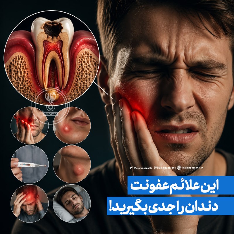 مجله پزشکی: این علائم عفونت دندان را جدی بگیرید!◽️عفونت دندان، به‌ویژه اگر درمان نشود، می‌تواند از محل دندان به فضاهای اطراف فک، زیر