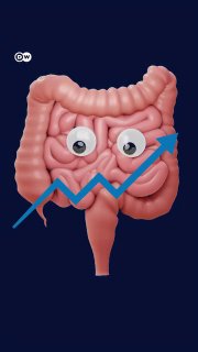 Increase in colon cancer among young people The number of people under the age of 50 diagnosed with colon cancer is increasing.