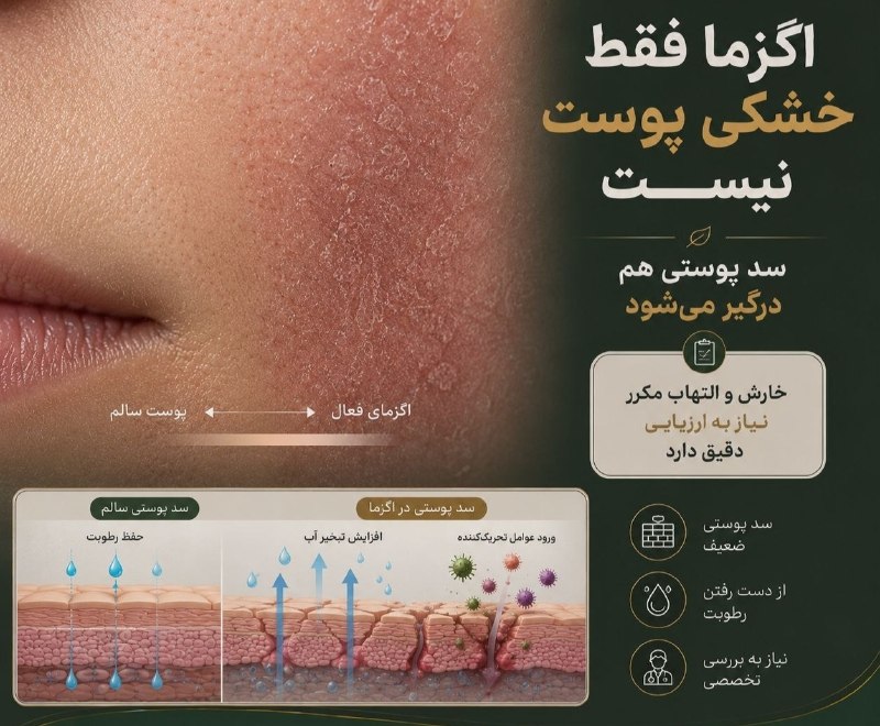 خبرازما: 🟡 اگزما فقط خشکی پوست نیست🧴 اگزما میتواند باعث خشکی، خارش، التهاب و تغییرات ظاهری پوست شود و در برخی افراد دورهای عود