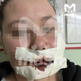 250 рублей компенсации получила жительница Уфы за шрам на пол-лица, который она получила после аварии на скорой помощи. ДТП произошло в октябре 2025 года на улице Бакалинской: столкнулись автомобиль скорой помощи Ford и пикап Dodge RAM. После удара реанимо