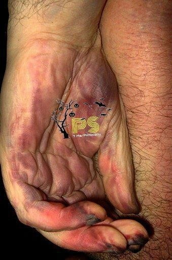 ترسناک | Scary: جالبه بدونید لکه های در کف دست جسد نشان دهنده این هستند که فرد در اثر خفگی کشته شده است...@pmscary