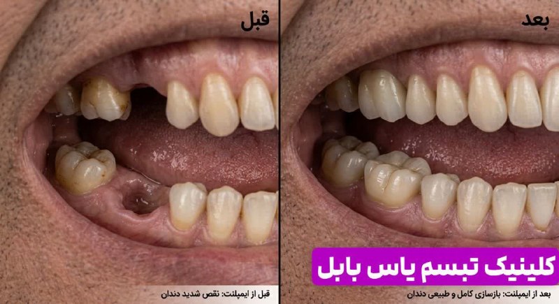 کانال بابل شهر بهار نارنج: ❌ صف مردم مازندران برای کاشت دندان (ایمپلنت) در این کلینک دندان پزشکی بابل با ویزیت رایگان❗️▫️تنها و تنها تا آخر شهریور 