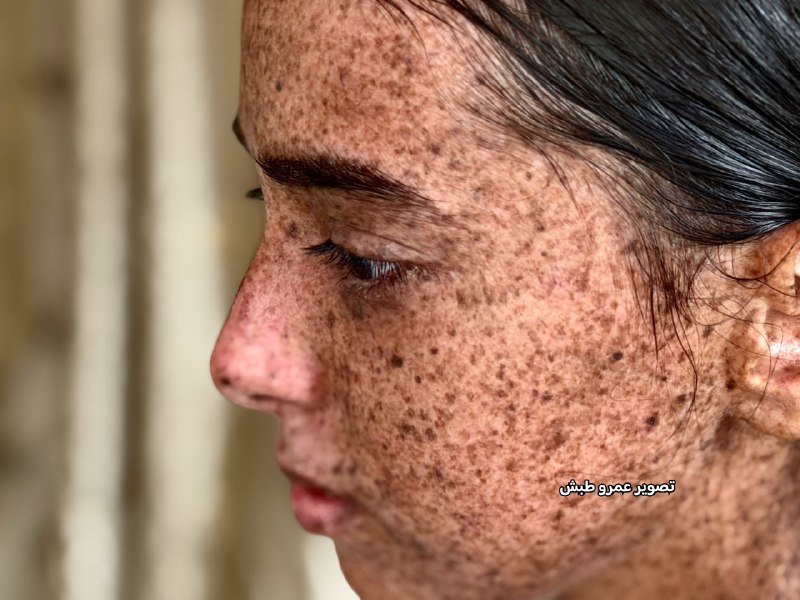 طفلة بـ14 سنة تواجه مرضاً نادراً وتنمراً قاسياً