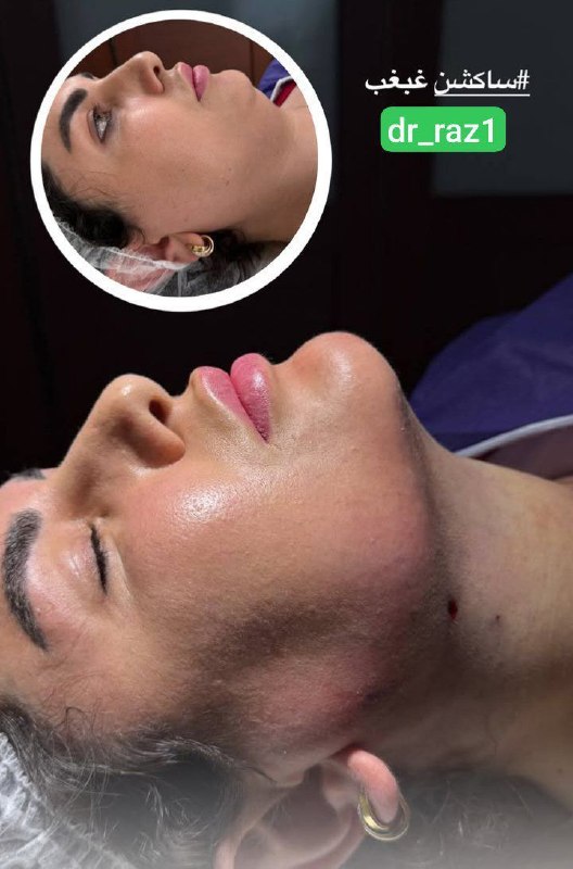 چیتگری ها: با وی لاین 💎 صورتت رو کشیدهتر و جذابتر از همیشه کن 😍 (بدون دوران نقاهت سنگین!)💉 طراحی کاملا اختصاصی بر اساس فرم چهره 🔥