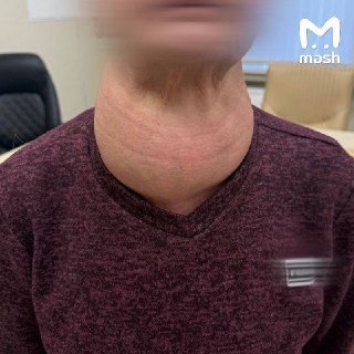 Опухоль щитовидки размером с голову выросла у пенсионерки из Татарстана — она 40 лет не могла решиться на операцию. Пациентку долгое время мучила астма, было тяжело дышать — зоб разросся и начал сдавливать трахею. Женщина могла задохнуться в любой момент. 