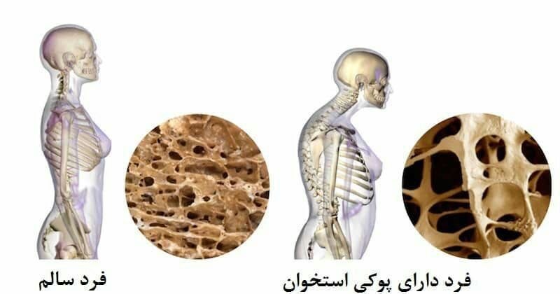 دورنمای پشته (دوستداران احیای محل): 🔹 معجون برای پوکی استخوان:🔸چهار مغز+ کنجد+ پونه کوهی+ زنیان+ زیره سبز+ زیره سیاه+ رازیانه+سیاهدانه+ کشک+جوزهندی+ زعفران.