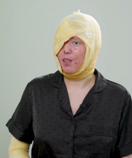 «95% пересаженной кожи прижилось». Жертва вернувшегося с СВО маньяка, который из ревности облил ее кислотой, пошла на поправку. Преступник в СИЗО, но грозил снова уйти на фронтОперация по пересадке кожи Анастасии Прокофьевой прошла в целом успешно. 95% кож