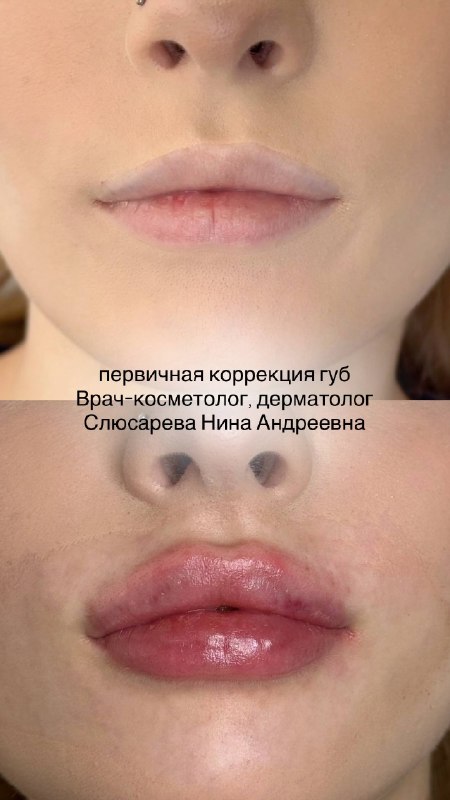 Первичная коррекция губ 😍