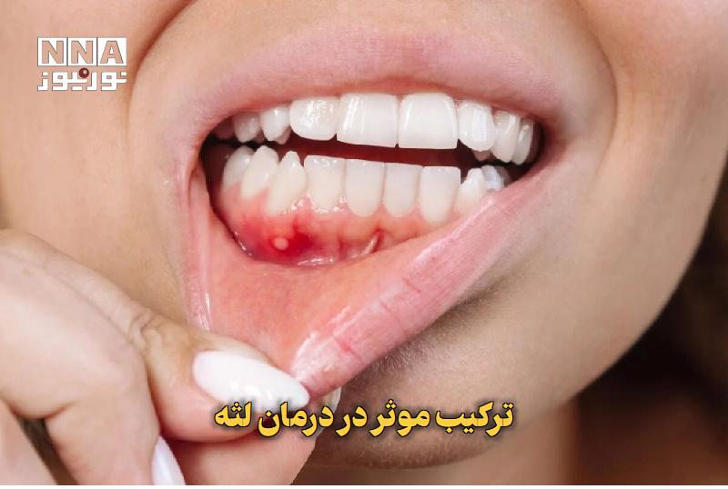 نورنیوز: ✅ ترکیب موثر در درمان لثه🔹 پژوهشگران در مطالعه‌ای جدید دریافته‌اند که ترکیب امگا ۳ و آسپیرین با دوز پایین، در درمان بیما