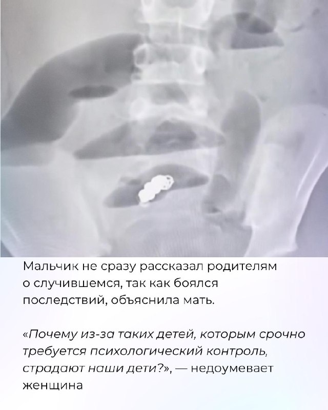 Мать рассказала, что старшеклассники заставили ее сына проглотить магнитный браслетАксессуар окислился — мальчику удалили часть кишечника.В Ташкенте ученик третьего класса школы №151 попал в реанимацию после того, как проглотил магнитный браслет. Его мать 