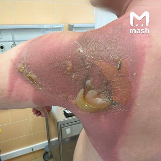 Парень из Татарстана сжёг спину, поспав на свежепостиранном новыми азиатскими капсулами постельном белье. Вечером 26-летний мужчина как обычно лёг спать, а утром проснулся от жесточайшего зуда и с багровой спиной в волдырях. Семья обратилась в РКБ, там ему