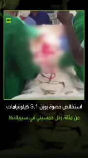 בתקרית רפואית נדירה שלפו רופאים בסרי לנקה אבן משלפוחית השתן של גבר בן 55 במשקל של כ-3.1 קילוגרם, מה שהפך או…