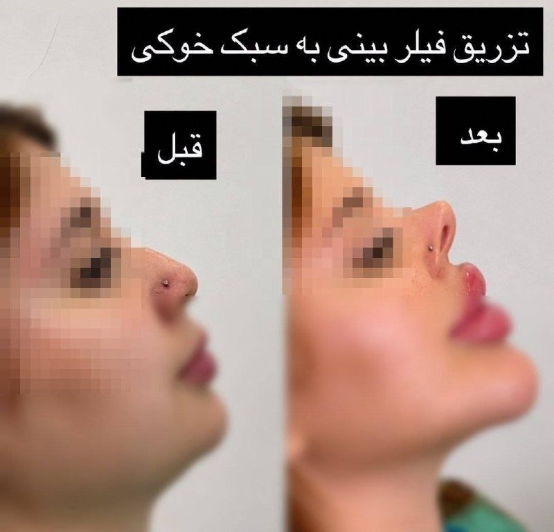 اخبار روز اقتصادی: «بینی به سبک خوکی»؛ وقتی طبیعی بودن دیگه کافی نیست!🔹یه زمانی عمل بینی برای اصلاح فرم بود، حالا بعضیا دنبال بینی‌ای هستن 